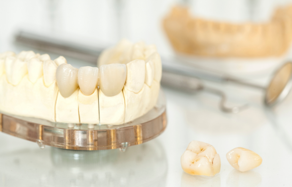 learn More About Our Dental Crowns in Mississauga, ON