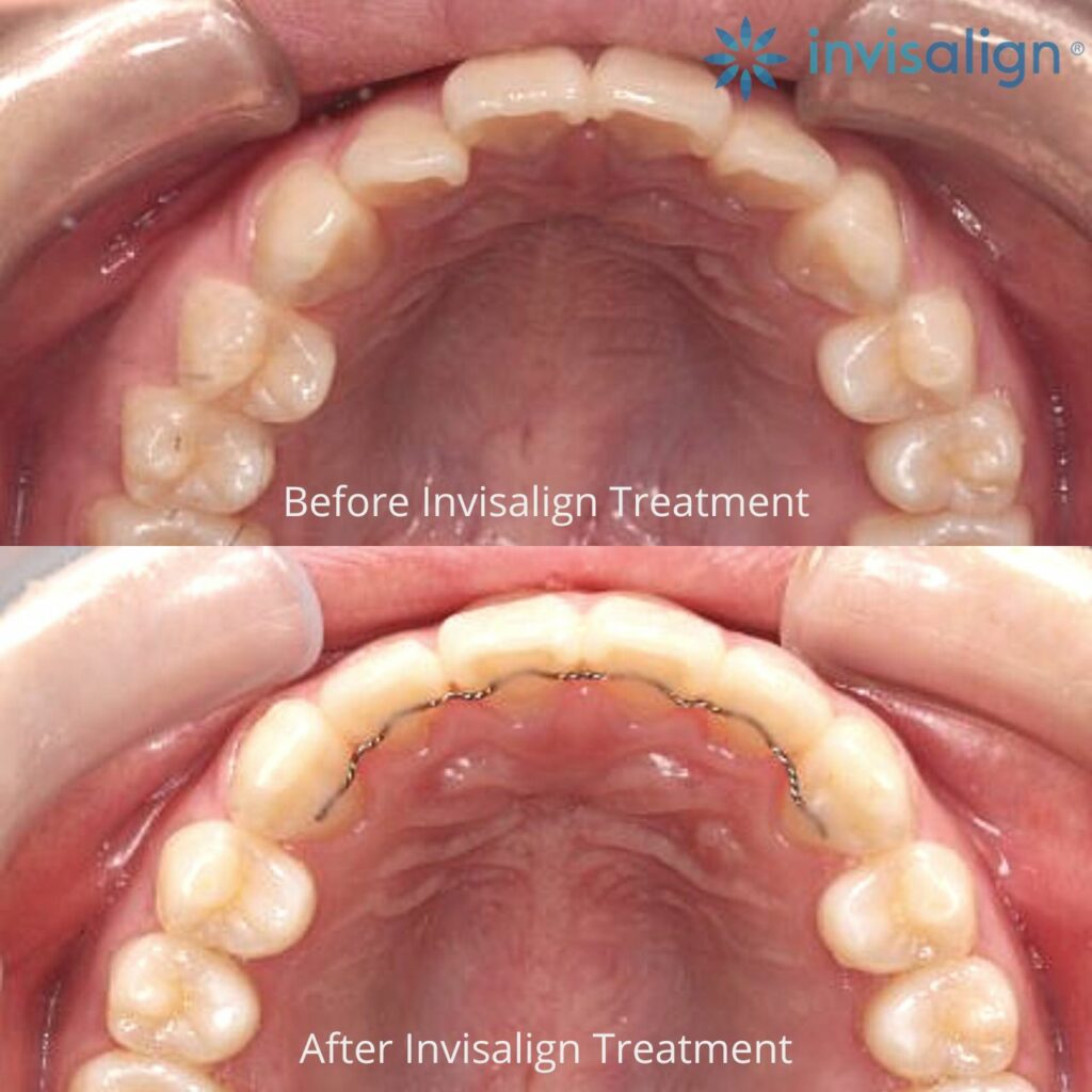 Invisalign - Onyx Dental