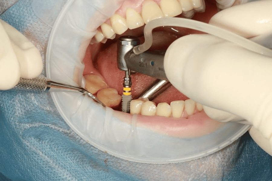 Dental Implant Advantages For Overall Health