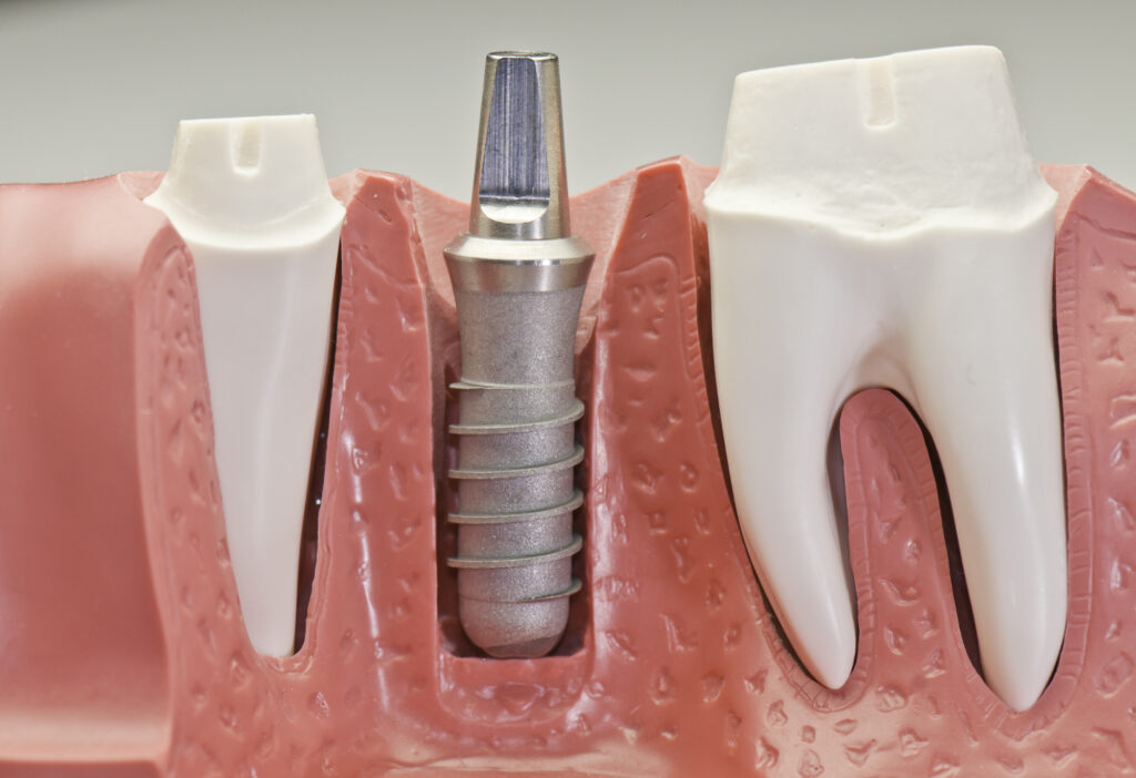 Dental Implant Advantages For Overall Health and Quality Of Life - Onyx Dental