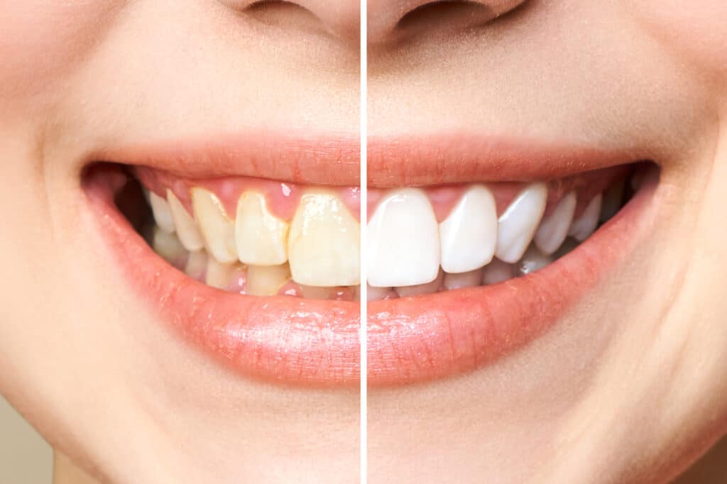 Teeth Whitening Mississauga - Onyx Dental