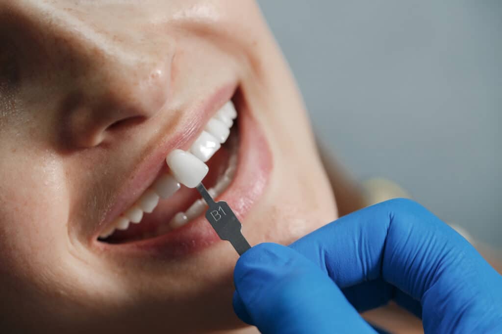 Dental Veneers Mississauga - Onyx Dental