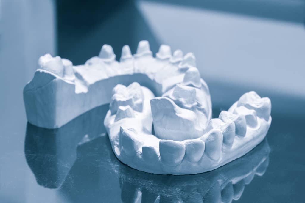 Dental Bridges Mississauga - Onyx Dental