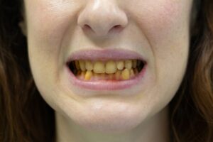 How To Make Yellow Teeth White