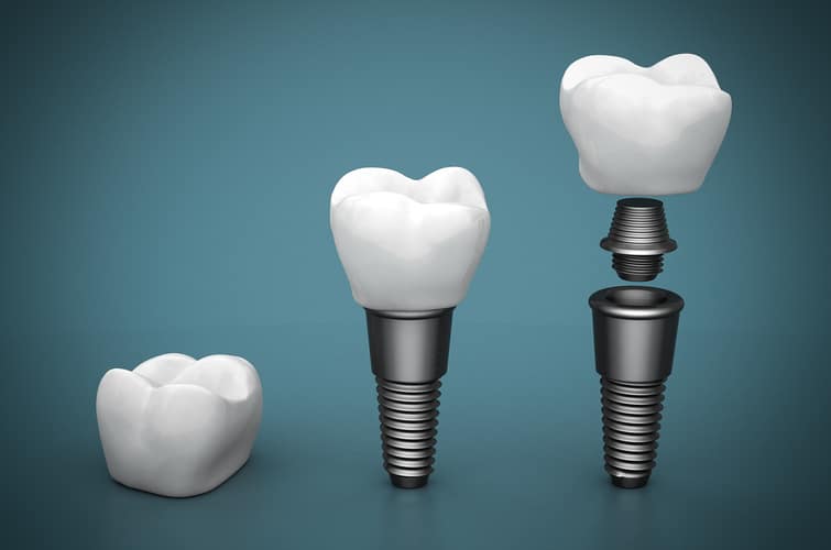 What Do Same-Day Dental Implants Involve