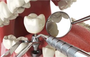 Benefits of Dental Implants