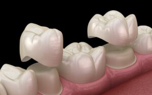 Benefits of Dental Crowns
