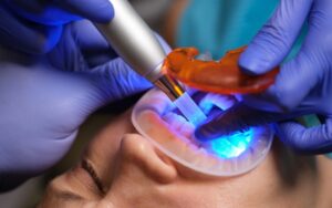 restoration teeth filling polymerization lamp dental light curing composite resin