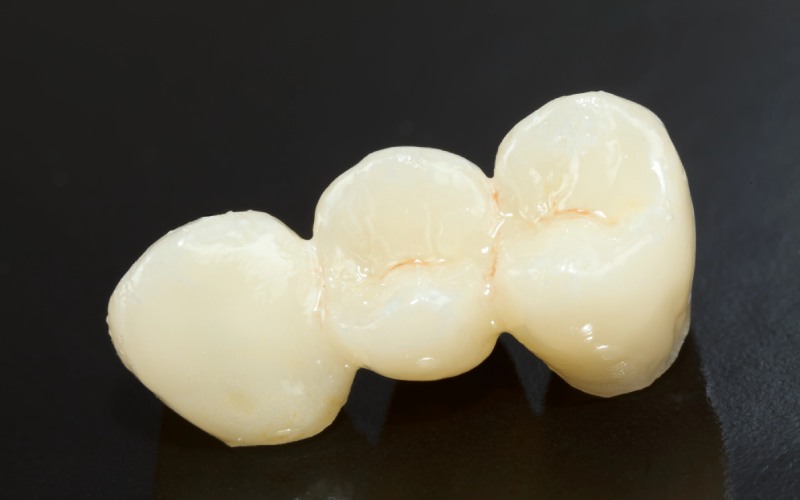 pressed ceramic teeth