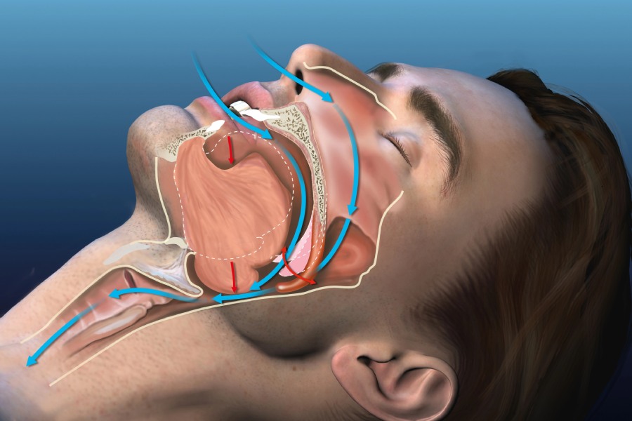 snoring medically 3d illustration